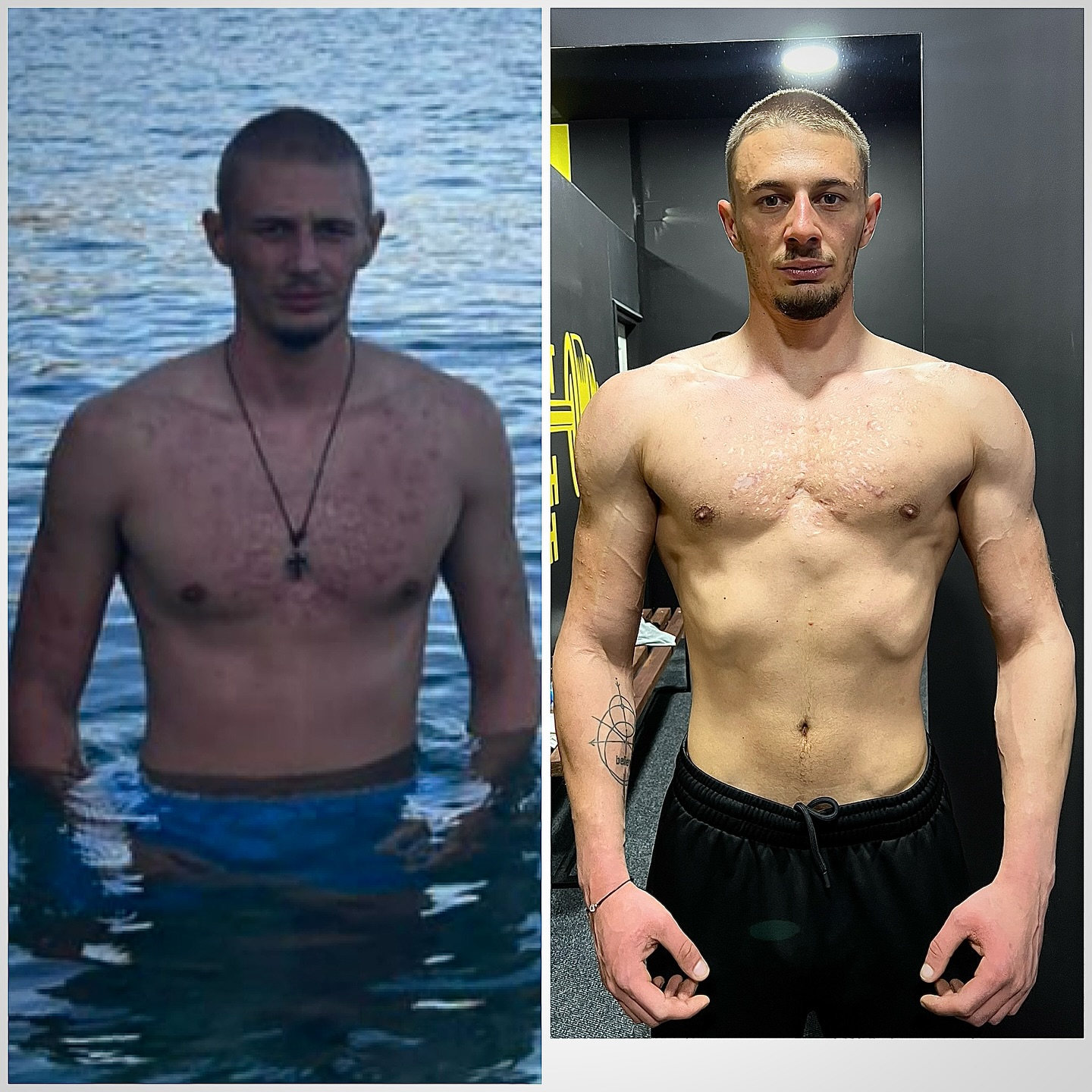 💥Novi rezultat u timu💥 Slika lijevo 60kg. Slika desno 76kg. Ovo je rezultat kada se spoje disciplina, znanje i povjerenje❗️ -Kada smo krenuli, ALT i AST su mu bili preko 450, stanje jetre ozbiljno narušeno, koža u jako lošem stanju. Prva 3 mjeseca radili smo online – fokus isključivo na zdravlje i vraćanje organizma u balans. Bez forsiranja. Ishrana, suplementacija i korekcija životnog stila su dali rezultate – vrijednosti ALT i AST smo vratili u referentne granice. -Tada kreće sljedeća faza: 1 na 1 treninzi. -U naredna 4 mjeseca radili smo pametno, planski i brutalno napredovali – +16kg kvalitetne mase, i obimi su pratili: – obim ruke sa 35cm na 42cm – obim prsa sa 99cm na 107cm – obim noge sa 49cm na 54cm Svaki obrok Svaki trening Svaki savjet – ispoštovan. Bez izgovora. Bez preskakanja. Samo rad. Ovo nije samo transformacija tijela – ovo je transformacija discipline, navika i mentaliteta. Ponosan sam što sam dio ovog puta i pored svih prepreka i dešavanja koje su te zadesile spartanski si odradio posao❗️ -Zapamtite kada se postavi ispravniji sistem i kada čovjek ima volju kao što je slučaj rezultati moraju da prate❗️ Bravo bruda 👏🏻🦾 @srrkii “Ako hoćeš rezultat – radi. Ako tražiš izgovor – zaboravi.” ☝️⏳🔥 . . . . . #transformacija #fitnesscoach #pratiprogram #zdravpristup #SpartaLifestyle #disciplinanarezultat #bezizgovora #motivation #whybenormalwhenyoucanbeabeast